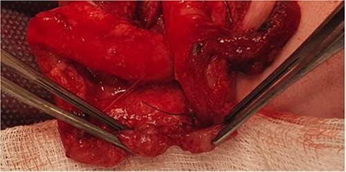 Intra-operative photograph of acquired colonic atresia in descending colon consistent with radiological findings in Fig. 1.