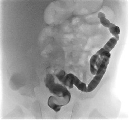 Contrast enema for case 2 showing complete failure of passage of contrast into distal transverse colon.