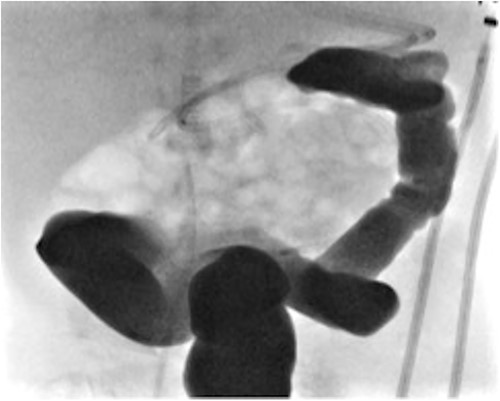 Contrast enema for case 3 showing complete failure of passage of contrast into distal transverse colon.