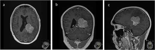 Pre-operative axial (a), coronal (b), and sagittal (c) T1-weighted post contrast MRI sequences demonstrating the avidly enhancing lesion in the posterior horn of the left lateral ventricle, with extension into the periventricular white matter.