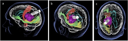 Lateral (a), ¾ lateral (b), and posterior (c) views of the pre-operative virtual 3D reconstruction model. The tumour (purple) is reached by the tubular retractor (white) and encircled by the associated white matter tracts: the CST (red) superiorly and anteriorly, and the IFOF (green) and the OR (yellow) that are located inferiorly, laterally, and posteriorly to the lesion.
