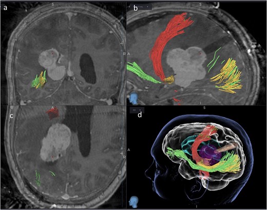 Coronal (a), sagittal (b) and axial (c) views of the merged images from intra-operative CT scans (O-Arm) with pre-operative MRI tractography. The tubular retractor is in situ. (d) Virtual 3D reconstruction of the tubular retractor (brown) in the merged images and its relationship with the tumour (purple), the CST (red), the IFOF (green), and the OR (yellow).