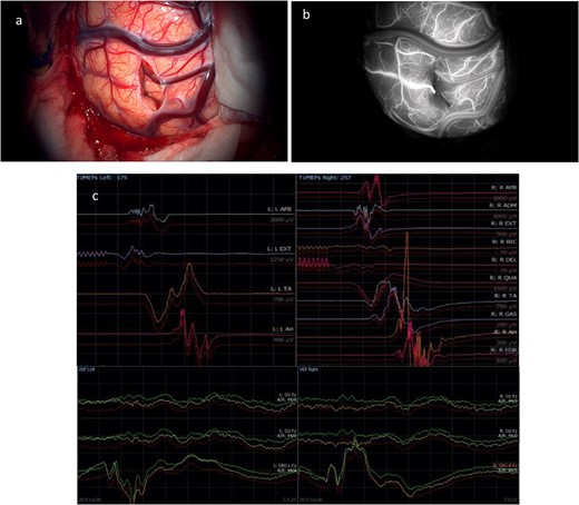 (a) Final microscopic view of the brain surface under bright light: the entry point of the operative corridor is visible at the level of the cortex, in the sulcus. (b) Microscopic final intraoperative view of the brain surface after indocyanine green injection: the vessels are represented without evidence of flow reduction or interruption. (c) Final screenshots of the intra-operative neurophysiology monitoring recorded with stable MEPs and VEPs responses (baseline in red).