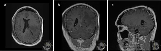 Post-operative axial (a), coronal (b), and sagittal (c) T1-weighted post-gadolinium MRI sequences of the Patient showing complete resection of the lesion with no evidence of post-operative surgical complications and complete collapse of the operative corridor pathway after removal of the tubular retractor.