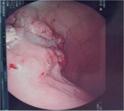 Large, circumferential, infiltrative, friable submucosal mass with erythematous overlying rectal epithelium, taking on the appearance of grape clusters.