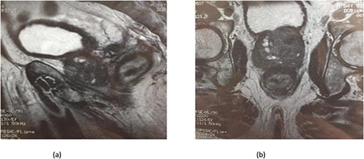(a) MRI features: circumferential wall thickening narrowing the rectal lumen and invading the prostate and the mesorectum without extrinsic mass on sagittal section of the pelvis. (b) MRI features: a cross section of the pelvis showing circumferential wall thickening narrowing the rectal lumen and invading the prostate and the mesorectum.
