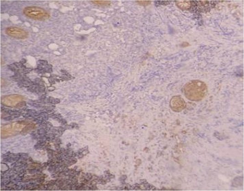 Positivity of immunohistochemical stains for pancytokeratin.