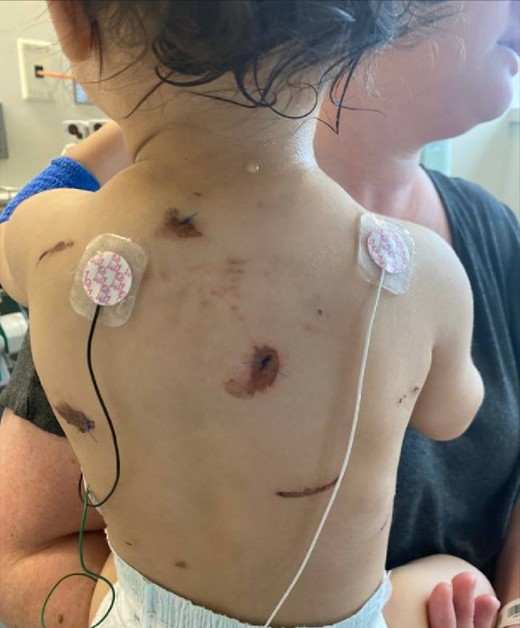 Image obtained during secondary survey of patient. Visible puncture wounds closed with suture closed during a prior encounter. Visible, presumed, CSF leaking from posterior aspect of the patient’s midline neck.