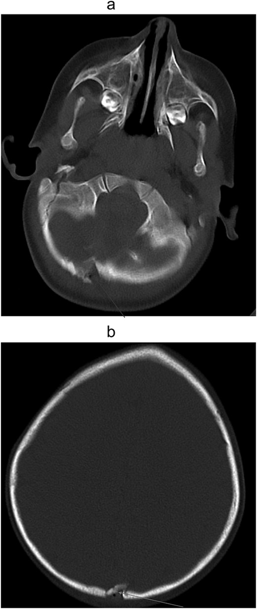 (a) Non-contrast computed tomography of head/brain, sagittal view showing Acute penetrating injury at three sites, with left parietal and occipital scalp laceration and associated depressed comminuted calvarial fractures. Trace extra-axial hemorrhage associated with the fracture of the inferior occipital calvarium and focal edema of the right cerebellar hemisphere, suggesting a small contusion and/or laceration. (b) Noncontract computed tomography of head/brain, sagittal view showing Acute penetrating injury at three sites, with left parietal and occipital scalp laceration and associated depressed comminuted calvarial fractures. Trace extra-axial hemorrhage associated with the fracture of the inferior occipital calvarium and focal edema of the right cerebellar hemisphere, suggesting a small contusion and/or laceration.