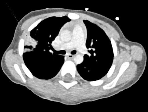 Intravenous contrast computed tomography of chest, abdomen, and pelvis showing right upper lobe pulmonary contusion/laceration. No pneumothorax or pleural effusion.