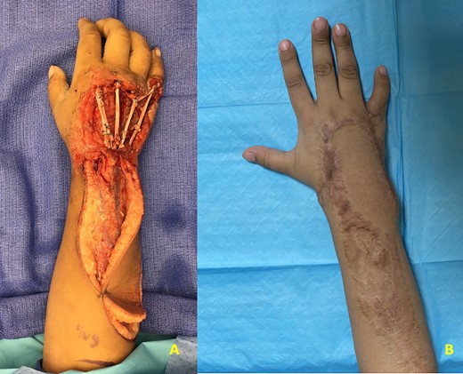 (A) Patient 4 intraoperative photograph of extensor tendon reconstruction using autografts. (B) Patient 4 postoperative photograph at 6 months.