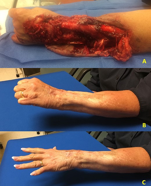 (A) Patient 1 preoperative photograph showing laceration and degloving injury to the forearm with loss extensor tendons. (B and C) Patient 1 postoperative photographs showing functional results at 12 months.
