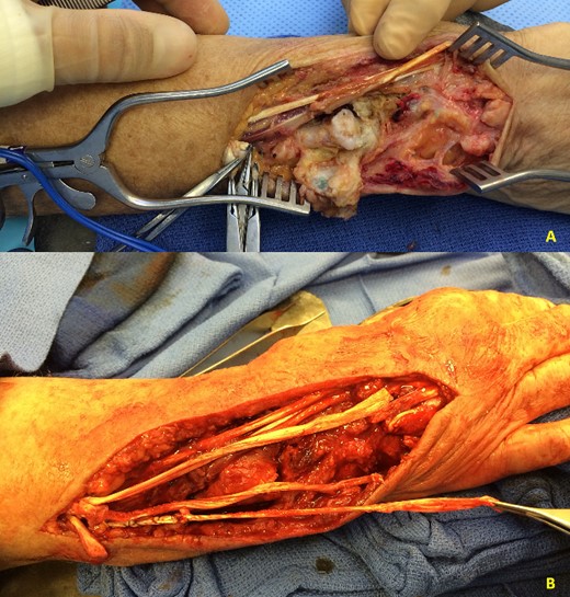 (A) Patient 5 intraoperative photograph showing chronic caput ulnae syndrome. (B) Patient 5 intraoperative extensor tendon reconstruction using autografts.