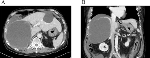 Dynamic CT showed a large cystic lesion (17 cm × 14 cm × 12 cm) in right liver (A), and also the cystic wall rupture under the right diaphragm (B).