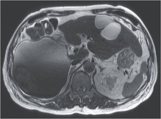 T2-weighted single shot turbo spin echo MRI showed a low intensity region with dorsal predominance in the high-intensity area, and fluid–fluid level.