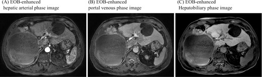 Gadoxetic acid (EOB) enhanced MRI didn’t show contrast effect with a cystic lesion in any phase.