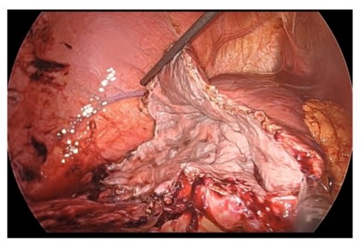 Resection in the cystic wall, remaining 2 cm on the liver side was left.