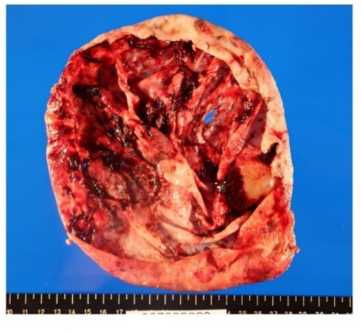 No neoplastic lesions were found within the resected cyst.