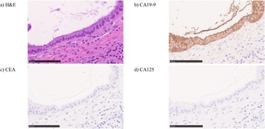In hematoxylin eosin staining (a), pathological findings of the cystic wall presented bile duct epithelium and liver lobules. Immunohistochemical, the hepatic cyst wall epithelium was only CA19-9 (b) positive, negative for CEA (c) nor CA125 (d).
