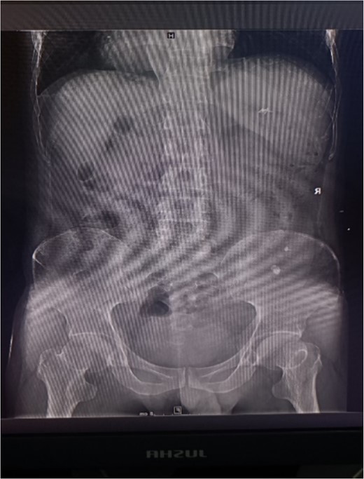 X-ray plain film showing multiple punctate stones in the right kidney area.