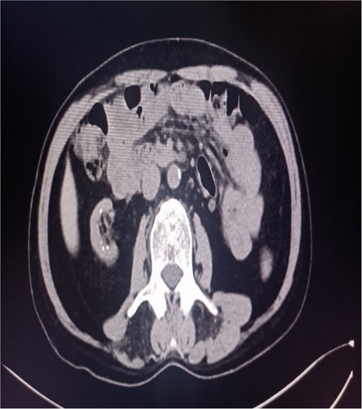 Abdominal CT showing multiple punctate stones in the right renal area in situ.