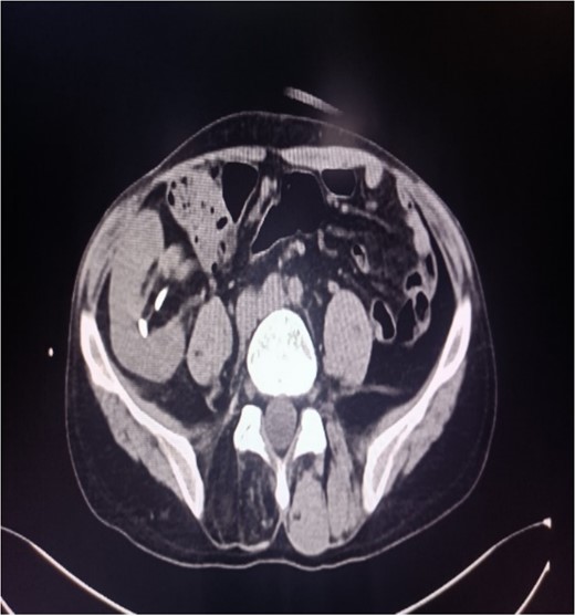 CT of the transplanted kidney shows stones.
