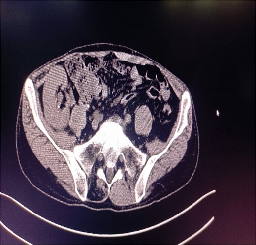 After removal of stones in the transplanted kidney.