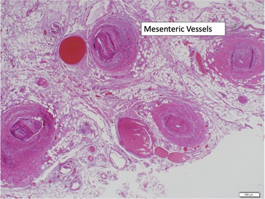 Mesenteric vessels with intramural inflammation.