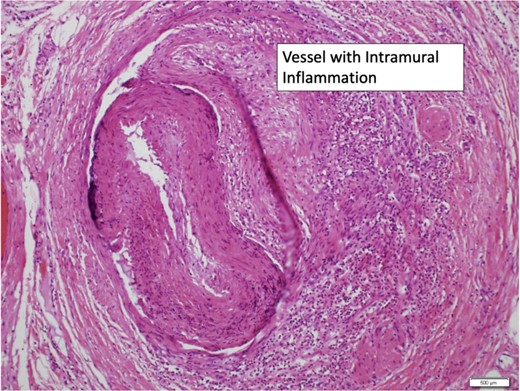 Mesenteric vessels with intramural inflammation.