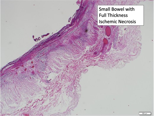 Small bowel with full thickness ischemic necrosis.