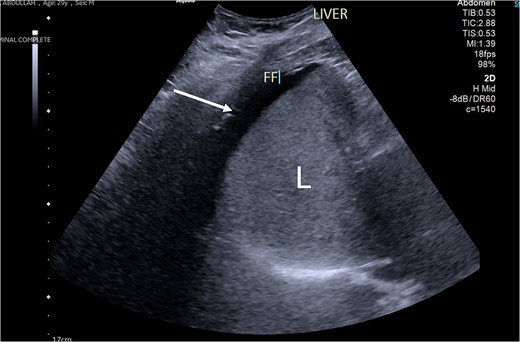 An ultrasound picture showing free fluid (FF) (white arrow) around the liver (L).