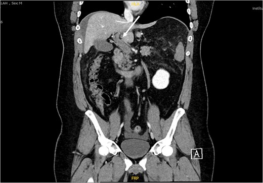 CT scan abdomen and pelvis, coronal view showing non enhancement of portal vein and its branches indicating venous thrombosis along the portal mesenteric axis (white arrow).
