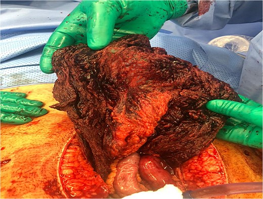 Intra-operative picture showing congested and infarcted omentum.