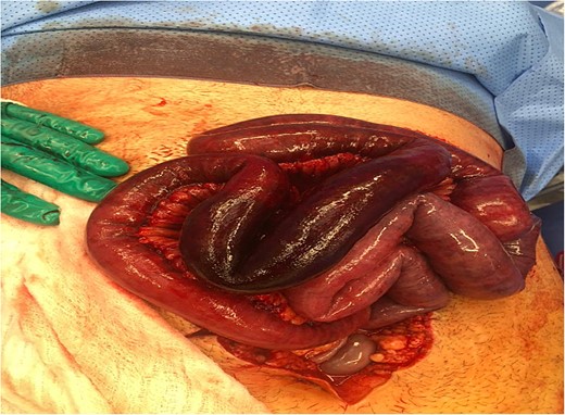 Intra-operative picture showing infarcted jejunal loop.