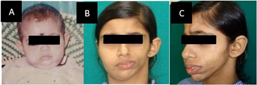 (A) Patient at 6 months of age without any deformity. (B, C) At presentation front and left oblique facial profile.