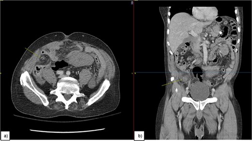 An image of the mass (pointing arrow) on (a) axial view showing Swerling sign, (b) coronal view.