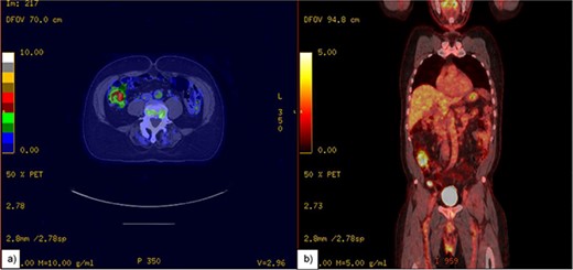 A PET-CT scan of appendix. (a) Thickening of the appendix measuring up to 1.4 cm with increased Fluorodeoxyglucose (FDG) avidity. (b) Showing appendix in coronal view.