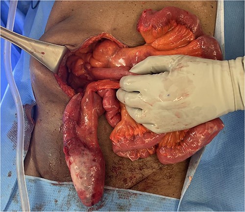 Intraoperative findings of small bowels and the appendix.