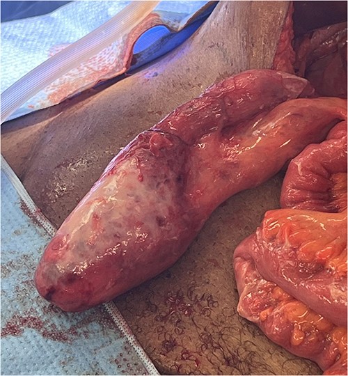 Intraoperative image of the appendix.