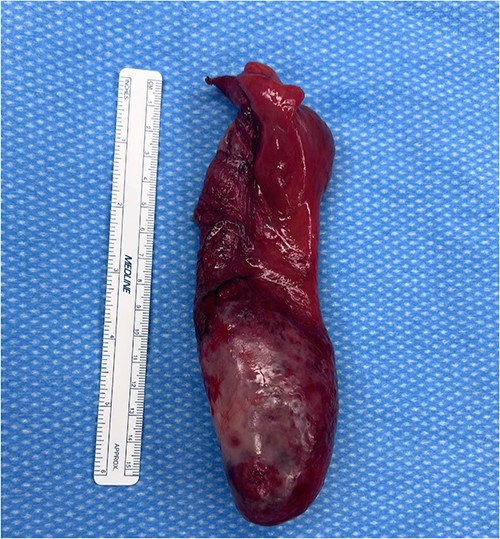 Appendix with a ruler next to it, measures ~17 cm in length and 5 cm in diameter.