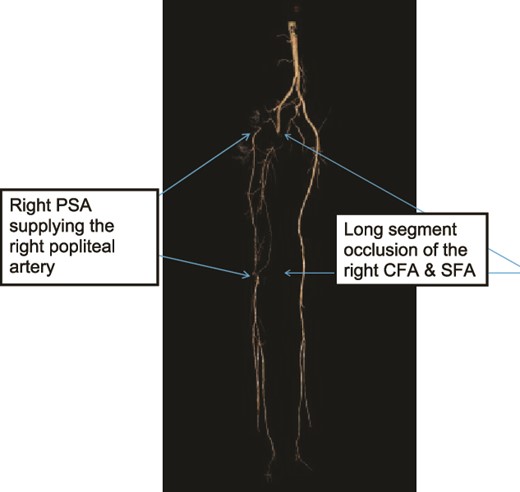 Case 1—3D-subtraction image of LL CTA oblique view of the bilateral LL arteries showing long segment occlusion of the right CFA and right SFA and right PSA.