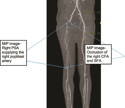 Case 1—3D-Maximum Intensity Projection image of LL CTA frontal view of the bilateral LL arteries showing long segment occlusion of the right CFA and right SFA; right PSA supplying the right popliteal artery.