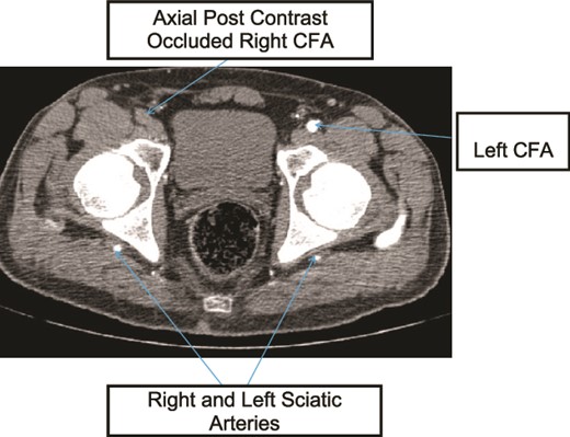 Case 1—axial image of LL CTA of the bilateral LL arteries at the level of the femoral head showing occlusion of the right CFA and bilateral PSA with larger caliber right PSA.