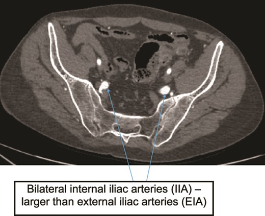 Case 2—axial image of LL CTA of pelvic cavity showing the IIAs larger size compared to the external iliac arteries.