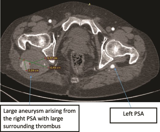 Case 2—axial images of LL CTA of the bilateral LL arteries at the level of the femoral head showing large bilateral PSAs and a large aneurysm with surrounding thrombus of the right PSA.