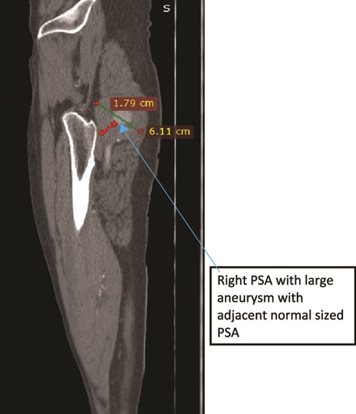 Case 2—sagittal images of LL CTA of the right LL arteries showing large aneurysm with surrounding thrombus with adjacent normal-sized PSA.