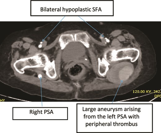Case 3—axial images of LL CTA of the bilateral LL arteries at the level of the CFA bifurcation showing large bilateral PSA and small bilateral SFA; large aneurysm with surrounding thrombus at the left PSA.