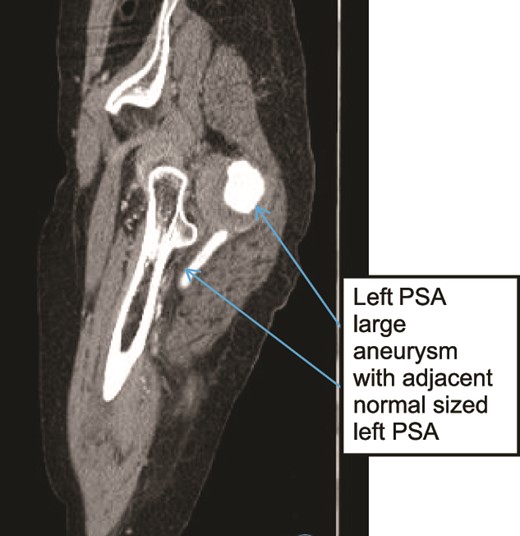 Case 3—sagittal images of LL CTA of the left LL arteries showing large aneurysm with surrounding thrombus with adjacent patent normal sized upper left PSA.