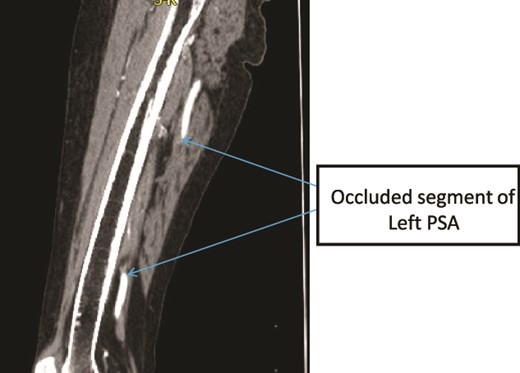 Case 3—sagittal images of LL CTA of the left LL arteries showing occluded left PSA in the mid-thigh.