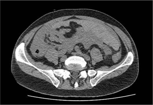 Computed tomography image on admission: moderate ascites with organized clot.